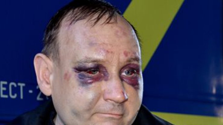 Шахтер с Донбасса о пытках в плену: Били за то, что бандеровец (фото, видео)