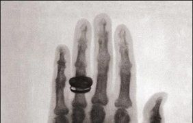 Первый рентгеновсий снимок человека (1896)