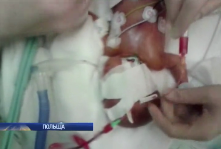 У Польщі лікарі дивом врятували недоношене немовля