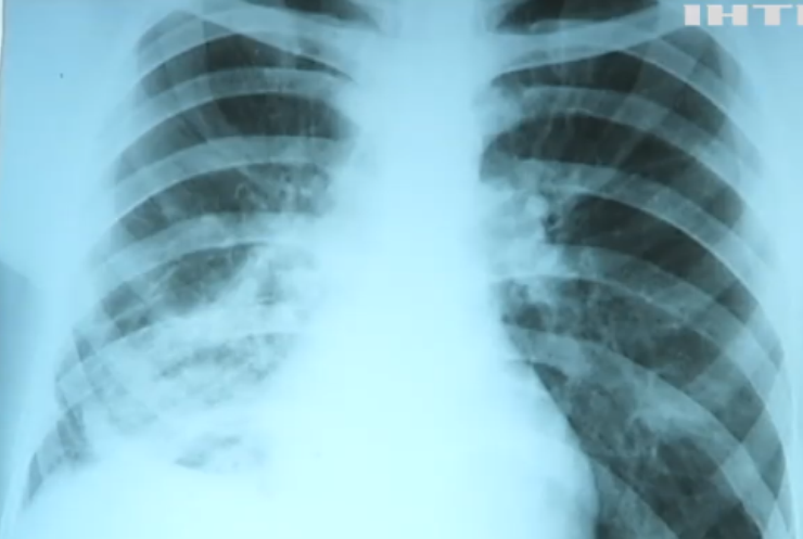 Україні загрожує епідемія туберкульозу: лікарі пояснили причину